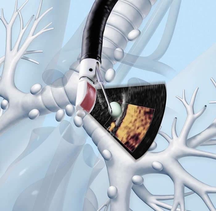 लिवासा अस्पताल, अमृतसर ने छाती की जटिल बीमारियों का शीघ्र पता लगाने के लिए अगली पीढ़ी का ईबीयूएस-एफएनए लॉन्च किया 1 IMG 20251124 WA0359